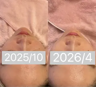 小顔&毛穴・肌質改善 LINDA西宮 AIのその他イメージ