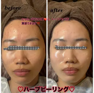 ハーブピーリング専門 毛穴洗浄❤️眉waxのエステ・リラクイメージ
