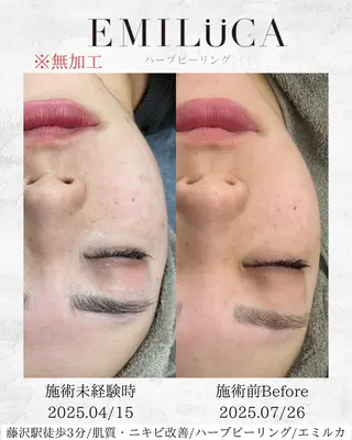 ハーブピーリング専門EMILUCA藤沢所属・ハーブピーリング /KAEDEのエステ・リラクイメージ