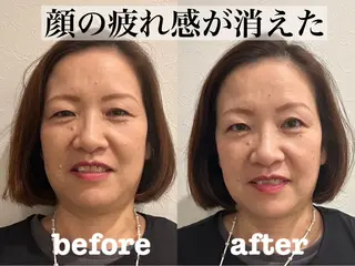 肌質改善×美容鍼 ゆいのエステ・リラクイメージ
