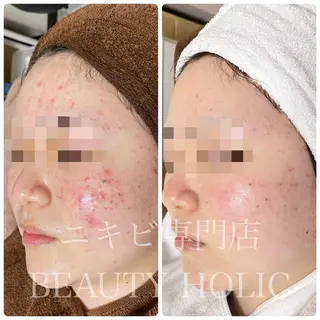 ニキビ・ 肌荒れ専門店のエステ・リラクイメージ