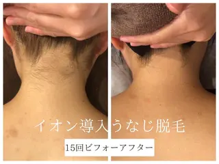 🎀うなじ脱毛🎀 ㅣLino堀江のエステ・リラクイメージ