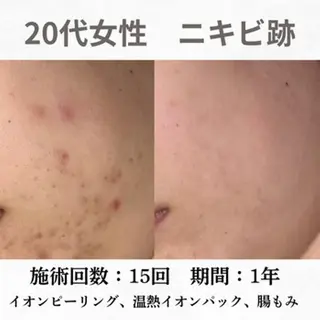 重度ニキビ専門🌷 ダウンタイムなしのエステ・リラクイメージ