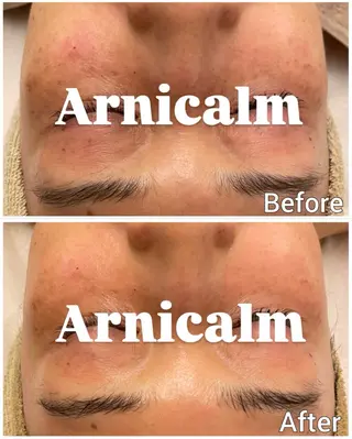 ハーブピーリング 肌再生ピーリング/のエステ・リラクイメージ