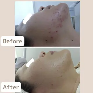 〈ニキビケアサロン〉 レゾン京橋店/ 浅川のエステ・リラクイメージ