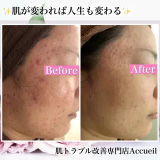 ミディアム カラー パーマ ヘアアレンジ メンズ キッズ ネイル マツエク・マツパ アイブロウ ニキビ・肌質改善専門 ♡人生が変わるサロンのエステ・リラクイメージ
