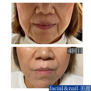 肌質改善◇結果重視 美麗-MIREI-のエステ・リラクイメージ