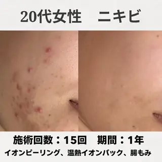 ニキビ跡改善専門🔥 医療にはできない改善のエステ・リラクイメージ