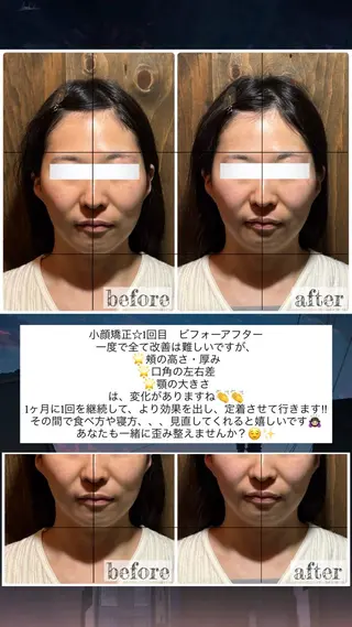 💎後悔させない小顔 矯正💎イトヤマ🌱のエステ・リラクイメージ