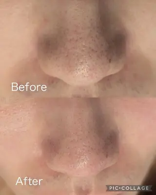 毛穴フェイシャルエステkokotto板橋所属・【毛穴ハーブピーリン グ】板橋1位のエステ・リラクイメージ