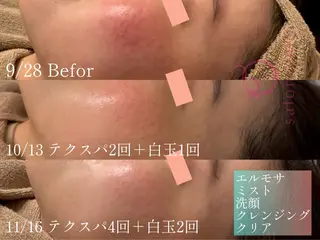 【ニキビ/肌管理】 salon varyのエステ・リラクイメージ