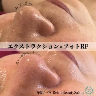 毛穴/シミ肝斑/脱毛 横山梨里のエステ・リラクイメージ