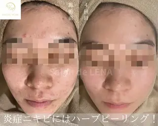 ハーブピーリング専門 グランディール　武内のエステ・リラクイメージ