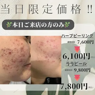 ハーブピーリング RAVIOS 森田のその他イメージ