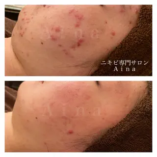 ロング カラー パーマ ヘアアレンジ メンズ キッズ ネイル マツエク・マツパ アイブロウ ニキビ跡専門サロン Ainaのエステ・リラクイメージ