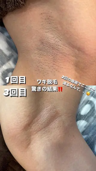 WAX・肌質改善・毛 穴洗浄/林愛真のエステ・リラクイメージ