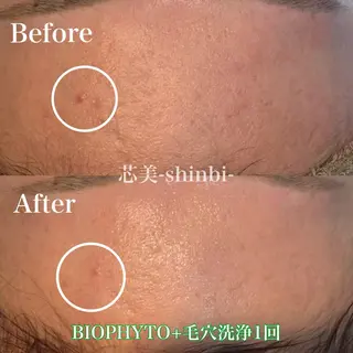 毛穴・ニキビケア ￤肌質改善￤EMIのエステ・リラクイメージ