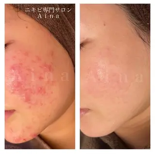 セミロング パーマ ヘアアレンジ メンズ キッズ ネイル マツエク・マツパ アイブロウ ニキビ跡専門サロン Ainaのエステ・リラクイメージ
