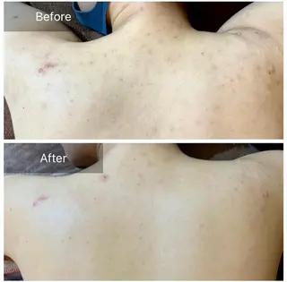 ニキビ・ニキビ跡🌿 ハーブピーリング✨のその他イメージ