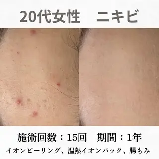 重度ニキビ専門🌷 ダウンタイムなしのエステ・リラクイメージ