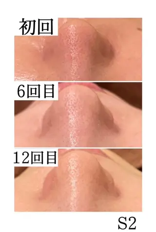3か月で肌革命👼 ニキビ専門店💫のエステ・リラクイメージ