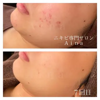 セミロング パーマ ヘアアレンジ メンズ キッズ ネイル マツエク・マツパ ニキビ跡専門サロン Ainaのエステ・リラクイメージ