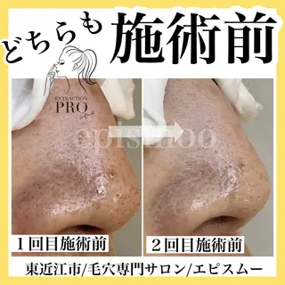 メンズ epismoo 脱毛/HBL/毛穴の眉毛・アイブロウイメージ