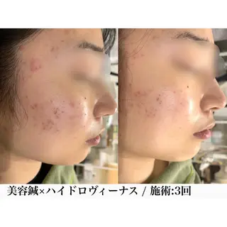 堀之内宏次 ［美容鍼灸師］のエステ・リラクイメージ