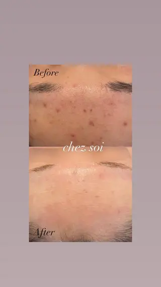 ニキビ/疲労回復ケア シェソワのエステ・リラクイメージ