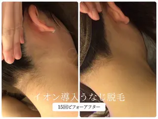 🎀うなじ脱毛🎀 ㅣLino堀江のエステ・リラクイメージ