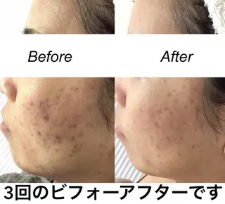 セミロング カラー パーマ ヘアアレンジ キッズ ネイル マツエク・マツパ 都度払い肌質改善 &脱毛Blancheのエステ・リラクイメージ