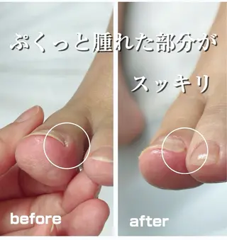 巻き爪フットケアサロンKotori所属・フットケアサロン Kotoriのその他イメージ