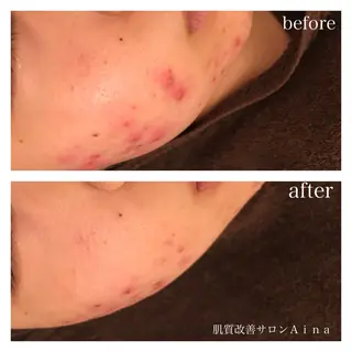 ミディアム キッズ ネイル マツエク・マツパ ニキビ跡専門サロン Ainaのエステ・リラクイメージ