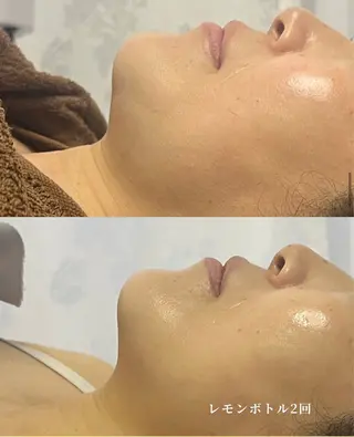 美肌毛穴ケア/看護師 🌷ナスサロmanaのエステ・リラクイメージ