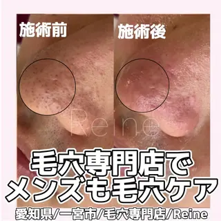 毛穴/シミ肝斑/脱毛 横山梨里のエステ・リラクイメージ