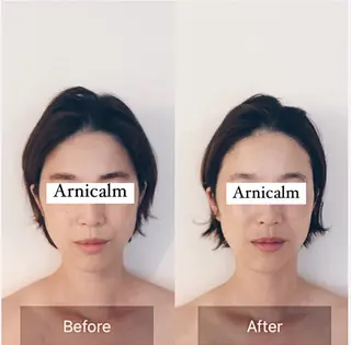 ハーブピーリング 肌再生ピーリング/のエステ・リラクイメージ