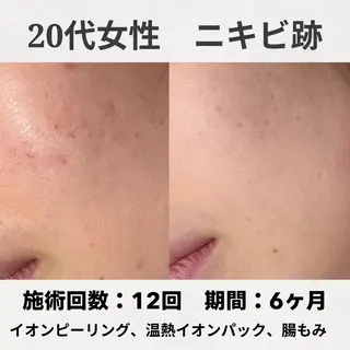 ニキビ跡改善専門🔥 医療にはできない改善のエステ・リラクイメージ