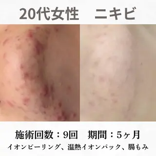 重度ニキビ専門🌷 ダウンタイムなしのエステ・リラクイメージ