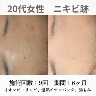 重度ニキビ専門🌷 ダウンタイムなしのエステ・リラクイメージ
