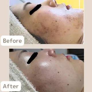 メンズ 〈ニキビケアサロン〉 レゾン京橋店/ 浅川のエステ・リラクイメージ