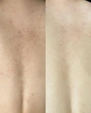 ニキビ・ニキビ跡🌿 ハーブピーリング✨のその他イメージ