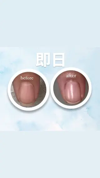 メンズ ネイル 爪ケア/深爪 自爪育成 🐰えむのネイルデザイン