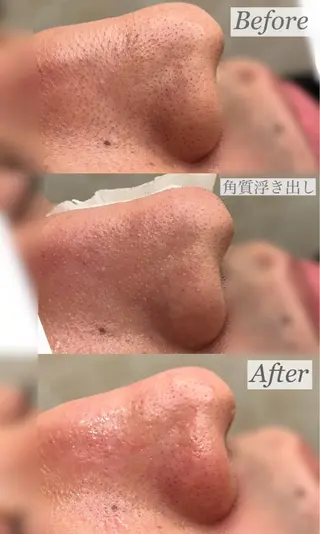 emiluca西目/ 毛穴洗浄/細胞美容のエステ・リラクイメージ