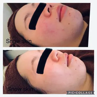 ニキビ/肌質改善専門 Snow skinのエステ・リラクイメージ