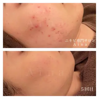 セミロング カラー パーマ ヘアアレンジ メンズ キッズ マツエク・マツパ アイブロウ ニキビ跡専門サロン Ainaのエステ・リラクイメージ