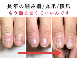 ネイル 深爪矯正・自爪育成 ネイルサロンアモここのネイルデザイン