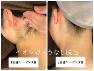 🎀うなじ脱毛🎀 ㅣLino堀江のエステ・リラクイメージ
