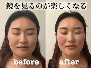 肌質改善×美容鍼 ゆいのエステ・リラクイメージ