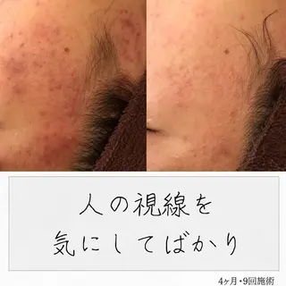 ニキビ経験者が施術 する専門サロン🌻のエステ・リラクイメージ