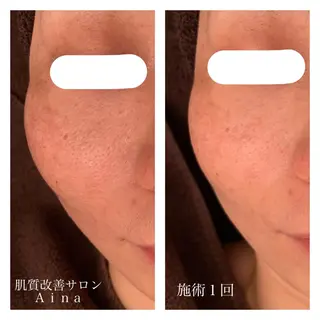 ロング カラー パーマ ヘアアレンジ メンズ キッズ ネイル マツエク・マツパ ニキビ跡専門サロン Ainaのエステ・リラクイメージ